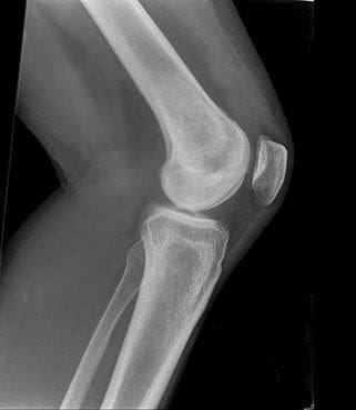 Vitamina D y osteoporosis